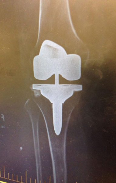 Экспериментальная стимуляция мозга может помочь отключить «пожарную сигнализацию» хронической боли