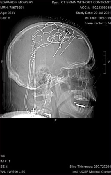 Экспериментальная стимуляция мозга может помочь отключить «пожарную сигнализацию» хронической боли