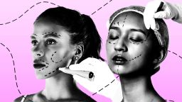 Пересадка волос у женщин процветает. Успех операции сложен.