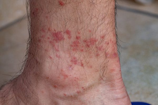 В Нью-Джерси зафиксирована первая смерть мужчины от аллергии на мясо, вызванной укусами клещей.