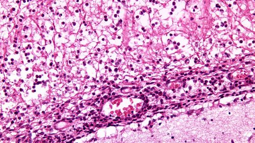 Школьников предупредили о потенциально смертельной болезни, которую можно принять за грипп или похмелье