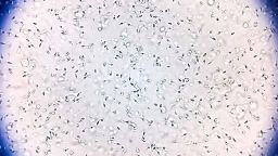 По меньшей мере 197 детей были рождены от доноров спермы, содержащих гены, вызывающие рак. Некоторые из них уже умерли. По меньшей мере 197 детей были рождены от доноров спермы, содержащих гены, вызывающие рак. Некоторые из них уже умерли.