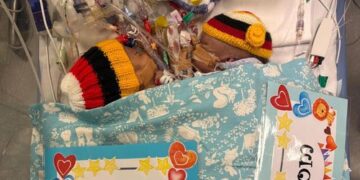 Один из сиамских близнецов, доставленных из Папуа — Новой Гвинеи, умер после экстренной операции в Сиднее.