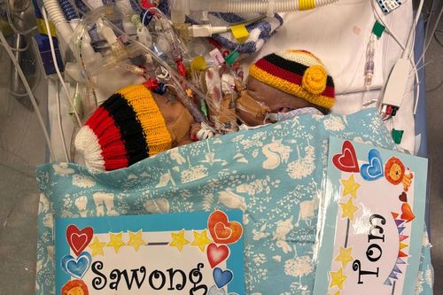 Один из сиамских близнецов, доставленных из Папуа — Новой Гвинеи, умер после экстренной операции в Сиднее. Один из сиамских близнецов, доставленных из Папуа — Новой Гвинеи, умер после экстренной операции в Сиднее.