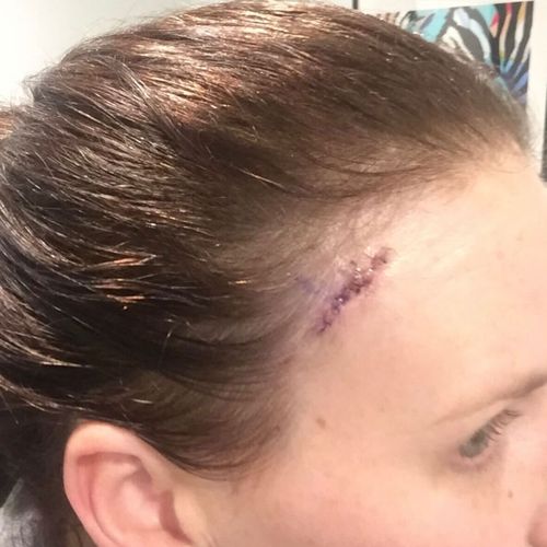 Крошечное пятнышко, найденное на лбу Сары, убивает 700 австралийцев каждый год