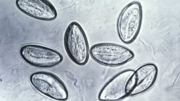 Паразитарное заболевание глаз, приводящее к слепоте, поражает в основном тех, кто носит контактные линзы. Вот как его избежать.