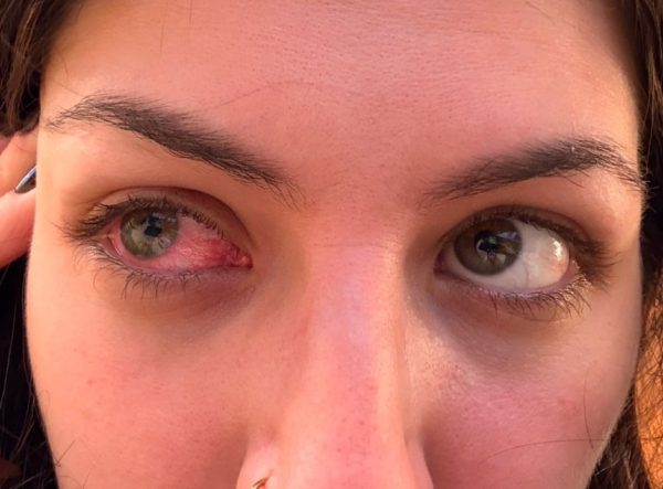 Паразитарное заболевание глаз, приводящее к слепоте, поражает в основном тех, кто носит контактные линзы. Вот как его избежать.