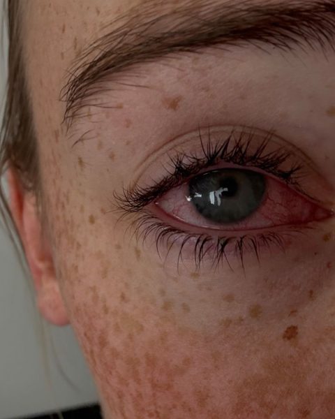 Паразитарное заболевание глаз, приводящее к слепоте, поражает в основном тех, кто носит контактные линзы. Вот как его избежать.