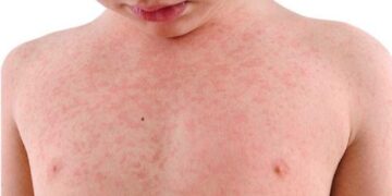 В Аделаиде невыявлена циркулирующая корь после выявления нового случая заболевания.