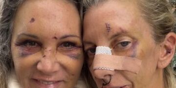 Отважные женщины из Сиднея, подвергшиеся жестокому нападению со стороны стоматолога, поделились фотографией, сделанной во время их выздоровления.