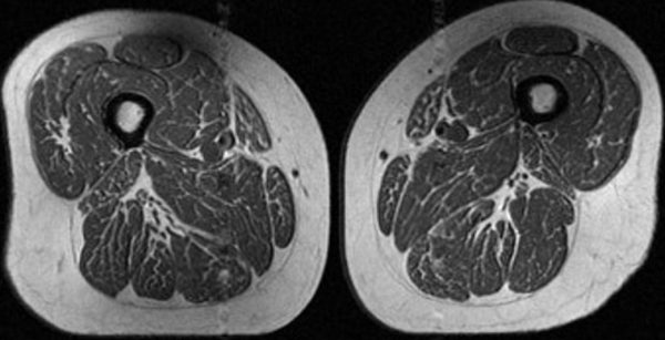 Ультрапереработанные продукты превращают человеческие бедра в стейки с ярко выраженной мраморной текстурой.
