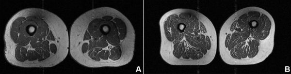 Ультрапереработанные продукты превращают человеческие бедра в стейки с ярко выраженной мраморной текстурой.