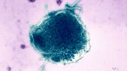 Центр по контролю и профилактике заболеваний (CDC) не учитывает 2 случая смерти от кори в Пенсильвании, что обостряет межпартийный конфликт. Центр по контролю и профилактике заболеваний (CDC) не учитывает 2 случая смерти от кори в Пенсильвании, что обостряет межпартийный конфликт.